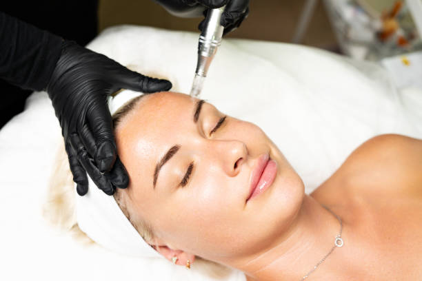Girl getting micro needling done